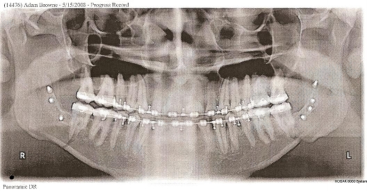 X-ray After Jaw Surgery